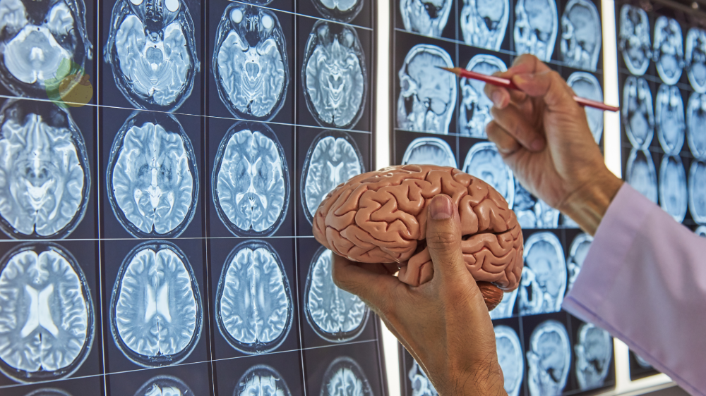 Anvisa aprova kisunla: primeiro medicamento no Brasil contra placas beta-amiloides do alzheimer